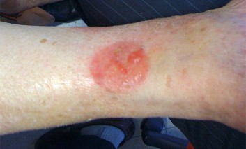 Contact Dermatitis due to Exelon Patch applied at the Wrong Site