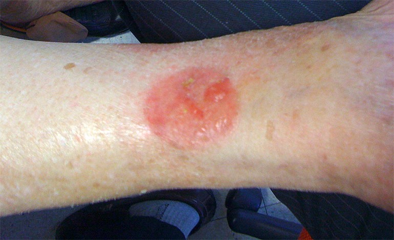 Contact Dermatitis due to Exelon Patch applied at the Wrong Site