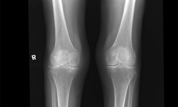 Osteoarthritis of Bilateral Knee Joints