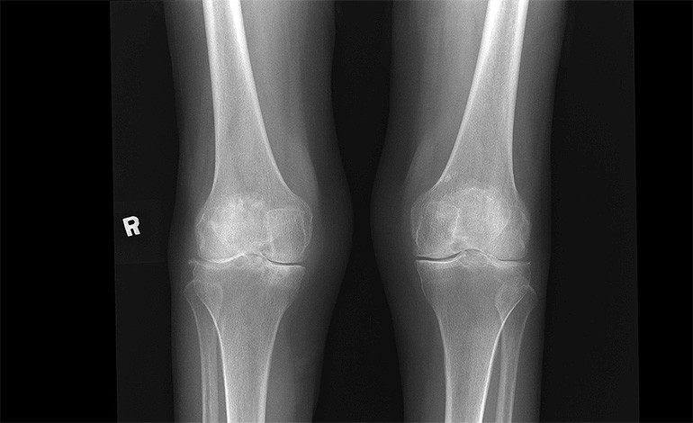 Osteoarthritis of Bilateral Knee Joints
