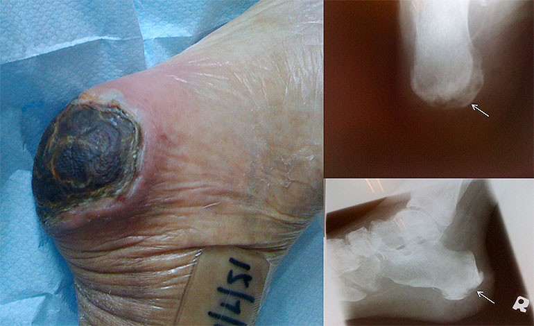 Infected Bedsores and underlying Calcaneal Osteomyelitis