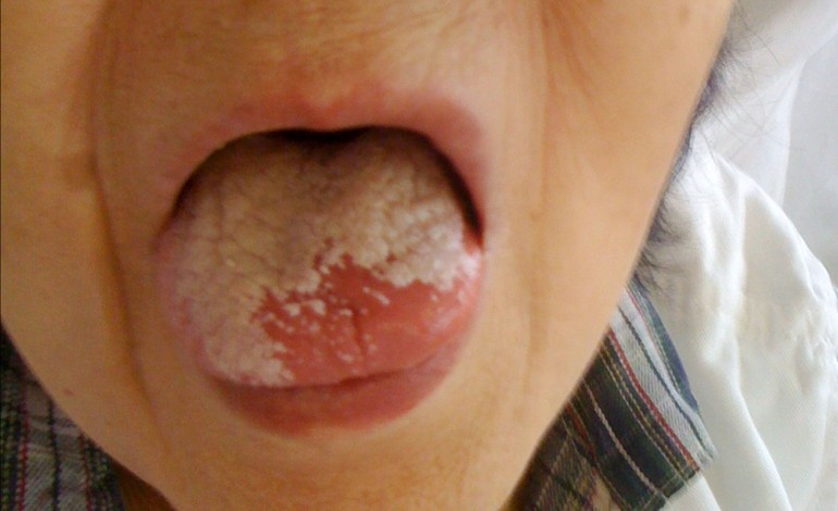 Oral Thrush due to Inhaled Corticosteroids