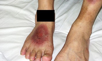 An Elderly Woman with a Recurrent Itchy, Circinate Rashes