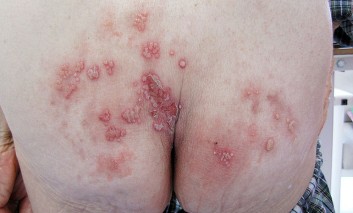 Painful Vesiculo-pustular Eruptions on the Buttock