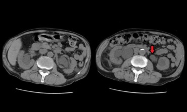 Hydronephrosis in CT