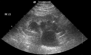 Hydronephrosis in Ultrasound