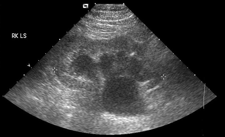 Hydronephrosis in Ultrasound