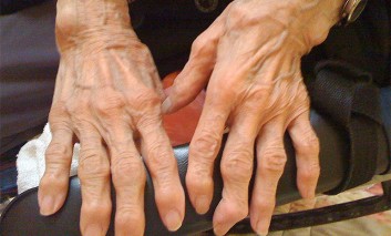 Osteoarthritic Changes of the Small Hand Joints