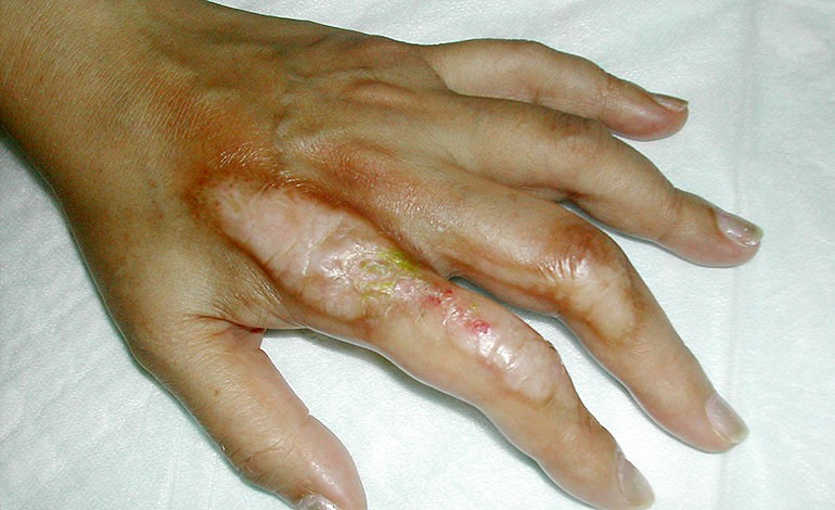 A Woman with Linear Thickening of Skin on Left Index and Middle Fingers