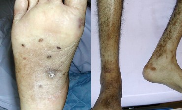 A Middle-aged Man with Pigmented Macules and Constitutional Symptoms