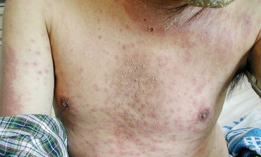 A Man with Pustular Dermatosis, Peripheral Eosinophilia and Deranged Liver and Renal Function Tests