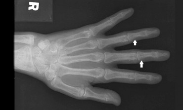 Renal Osteodystrophy of the Hands