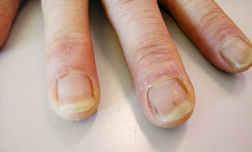 A Middle-aged Man with "Dark Lines" over Fingernails