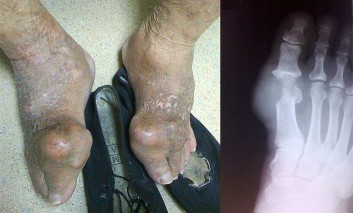 An Elderly Man with Tophaceous Gout