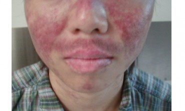 A 35 Year Old Woman Presents with Joint Pain, Mouth Ulcers and Facial Rash