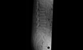 Renal Osteodystrophy of the Spine