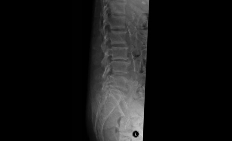 Renal Osteodystrophy of the Spine