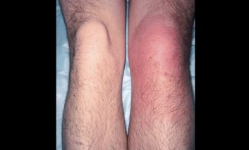A Young Man with a Swollen Knee Joint