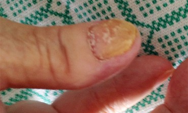 Onychomycosis