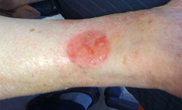 Contact Dermatitis due to Exelon Patch applied at the Wrong Site