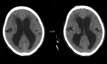 Normal Pressure Hydrocephalus