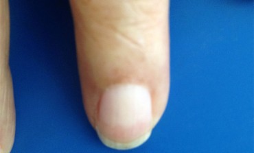 Lindsay’s Nail (Half and Half Nails)
