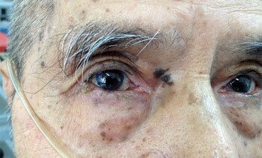 Staphylococcal Blepharitis