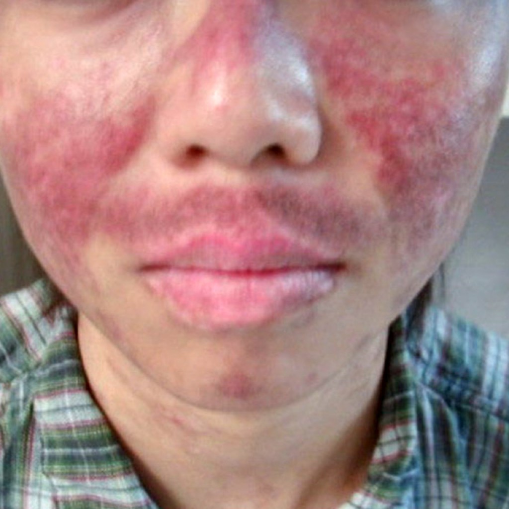 Clinical Signs and Radiographs of Patients with Rheumatological ...