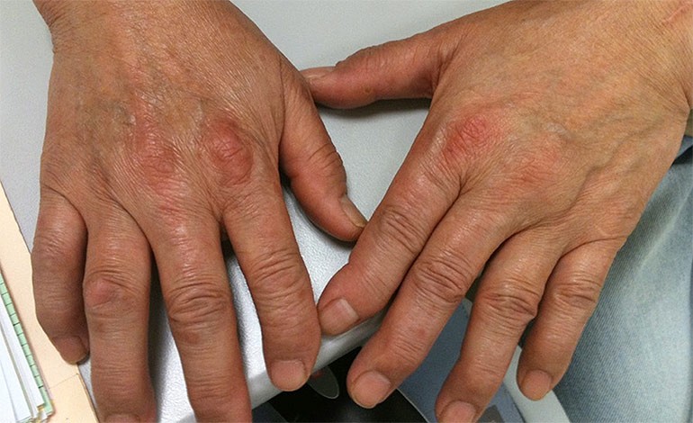 A Middle-aged Woman with Multiple Joint Pain