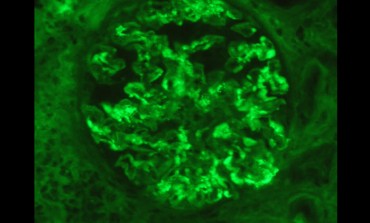 IgA nephropathy