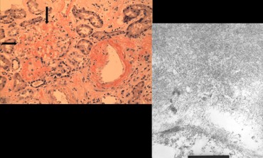 Amyloidosis