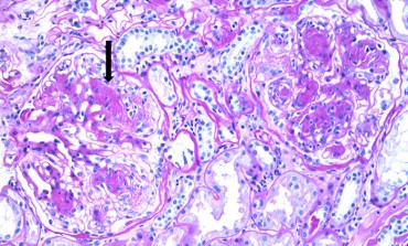 Diabetic Nephropathy