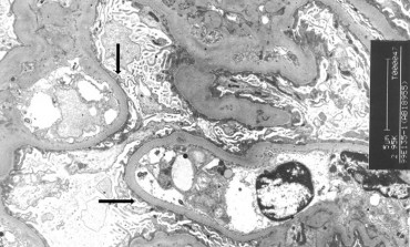 Minimal Change Nephropathy