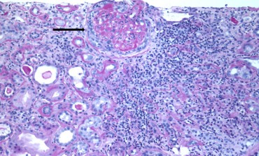 Rapidly Progressive Glomerulonephritis