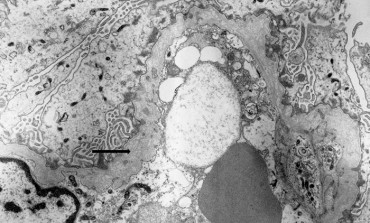 Alport’s Syndrome